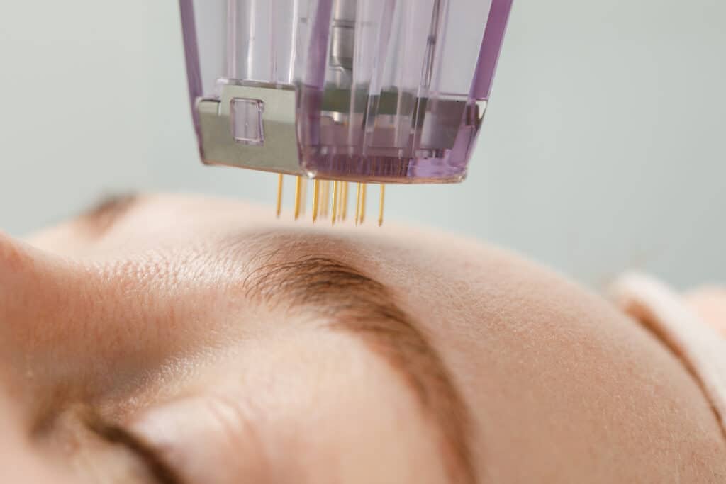 Microneedling : Soin du visage par micro-aiguilles Gros plan sur un stylo de micro-aiguillage (microneedling) avec des aiguilles dorées sur le front d'une personne près du sourcil.